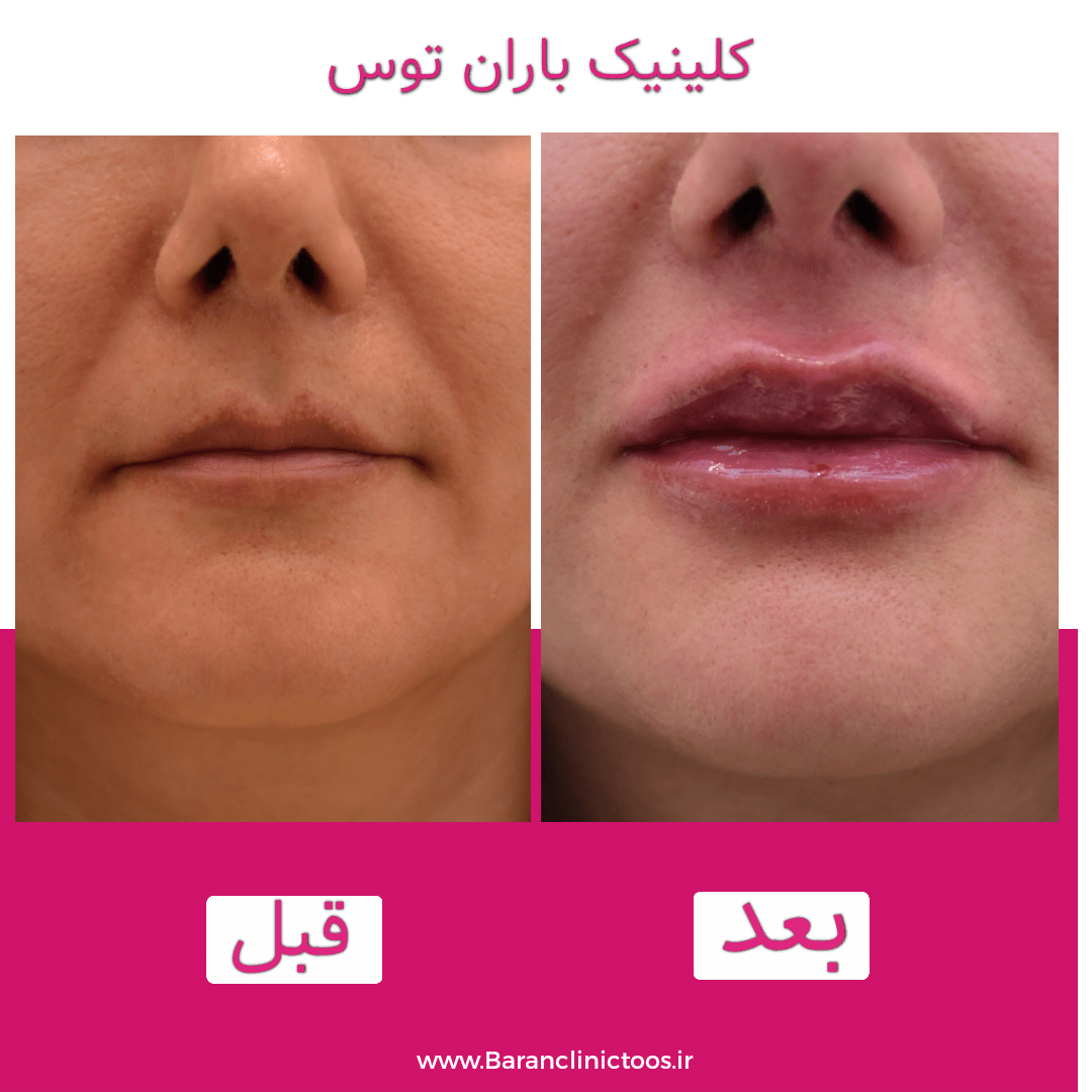 قبل و بعد فیلر لب